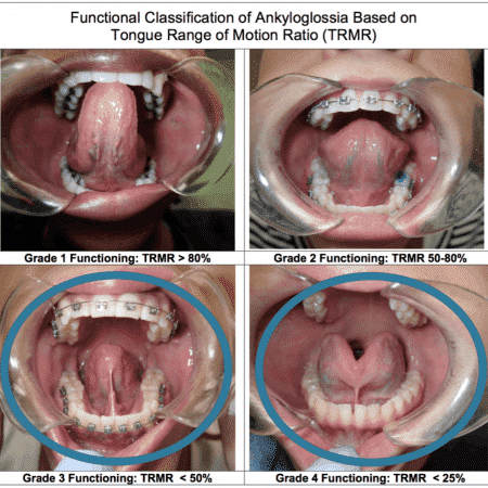 Adult Tongue Tie