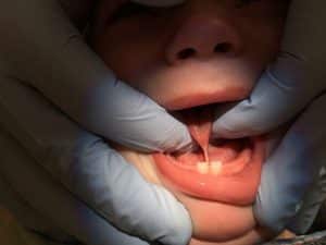 Infant Frenectomy
