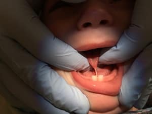 Tongue Tie