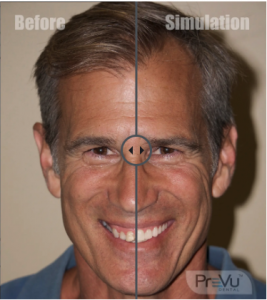 Smile Simulation Software