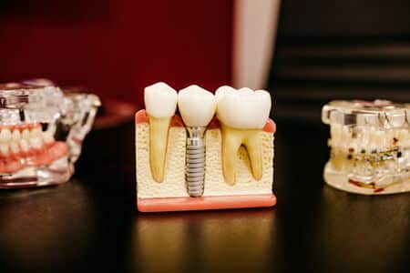 dental implants and crowns