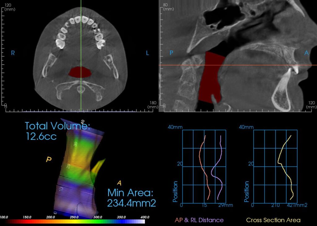 Color-mapped CBCT volumetric airway analysis at end of orthodontic care, age 11. Measured airway volume 12.6 cubic centimeters; minimum cross-sectional area 234.4 square millimeters.
