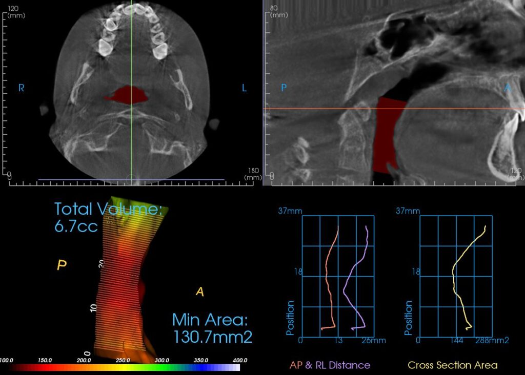 Color-mapped CBCT volumetric airway analysis at start of orthodontic care, age 9. Measured airway volume 6.7 cubic centimeters; minimum cross-sectional area 130.7 square millimeters.