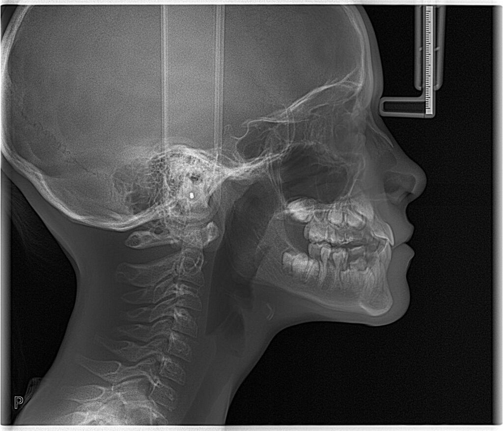 Lateral cephalometric CBCT image at end of orthodontic care, age 11, showing skeletal posture and mandibular position after two years of growth-window care.