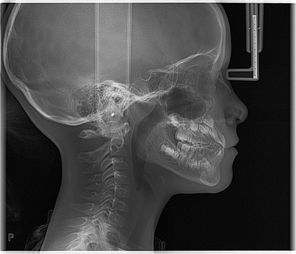 Lateral cephalometric CBCT image at start of orthodontic care, age 9, showing skeletal posture and mandibular position prior to treatment.